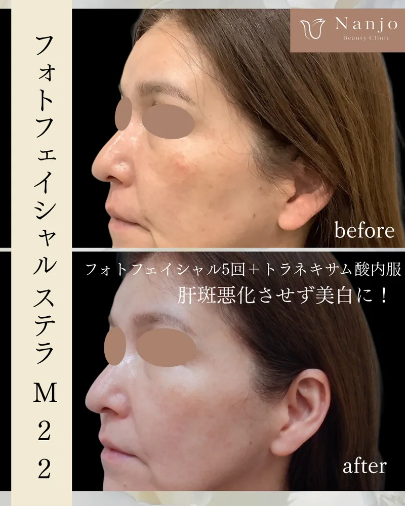 ステラM22でシミ・くすみ改善｜IPL光治療の特徴｜南條ビューティークリニック