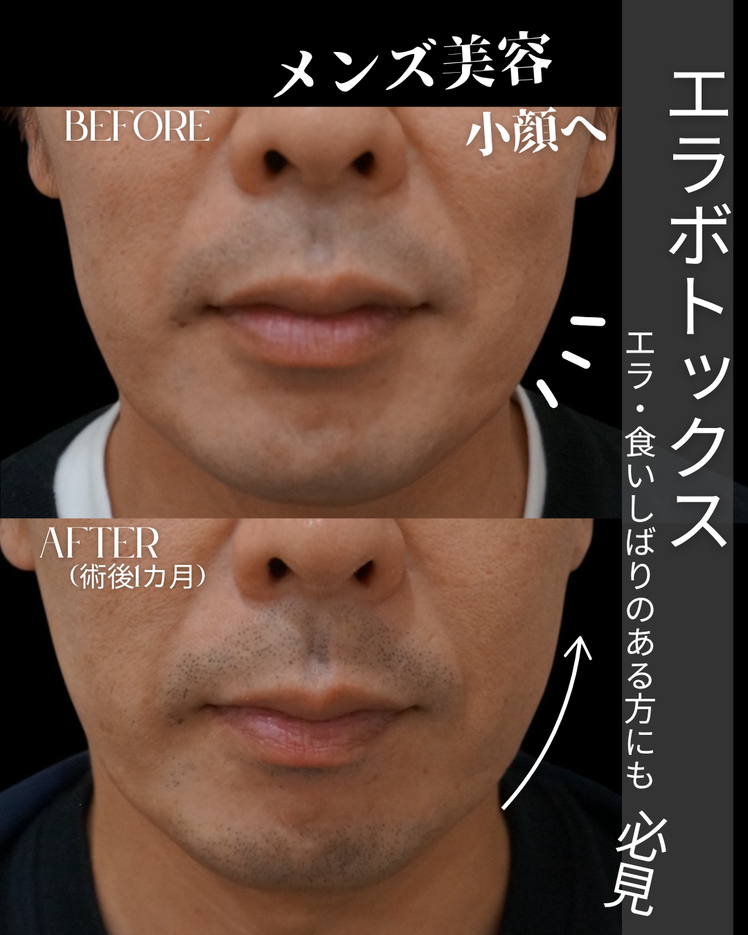 エラボトックス体験レポート｜40代男性｜南條ビューティークリニック 福岡