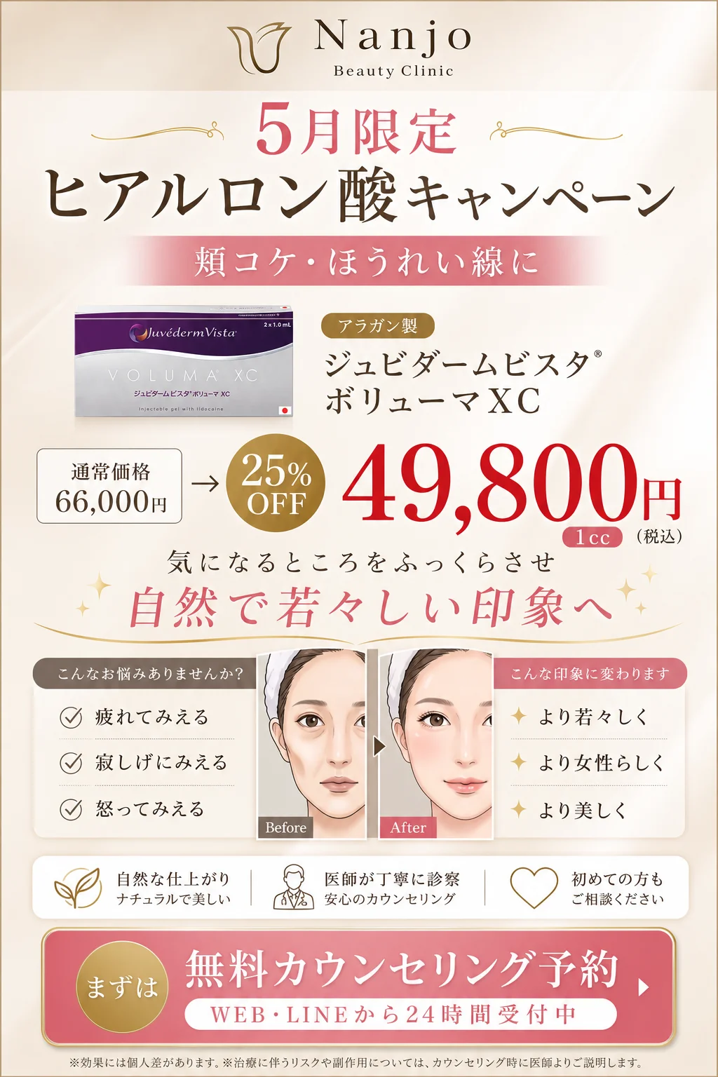 5月限定 ヒアルロン酸キャンペーン — ジュビダームビスタ ボリューマXC 1cc が25%OFF