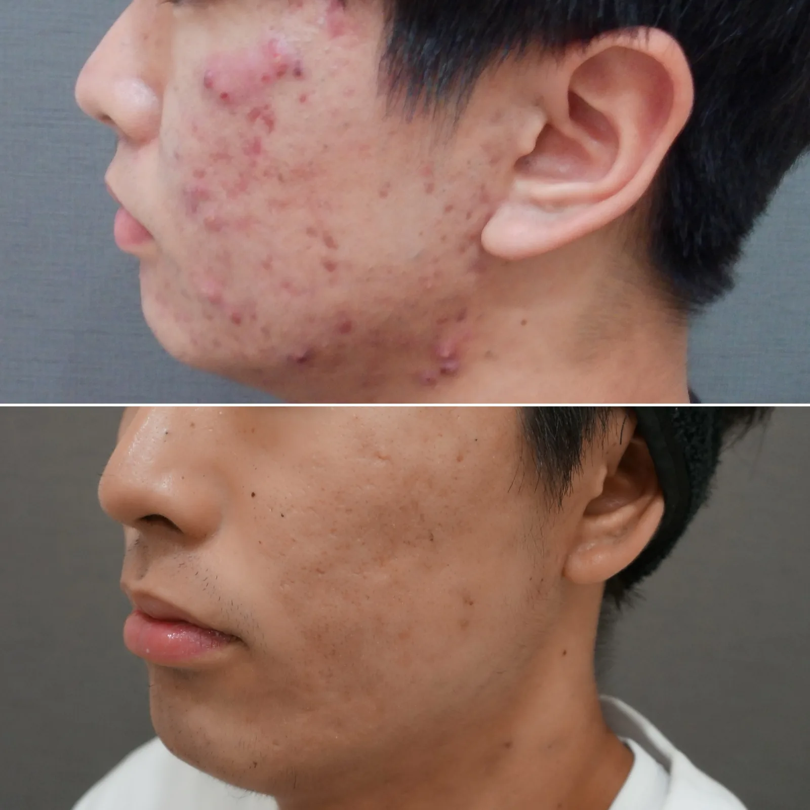 イソトレチノイン内服による重症ニキビ治療 症例2例