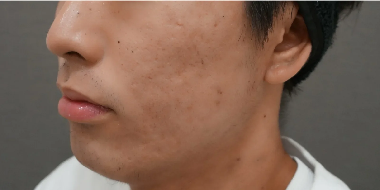 イソトレチノイン 症例A Before/After After