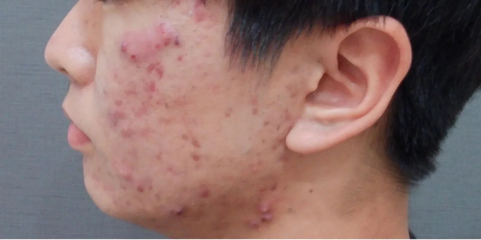 イソトレチノイン 症例A Before/After Before