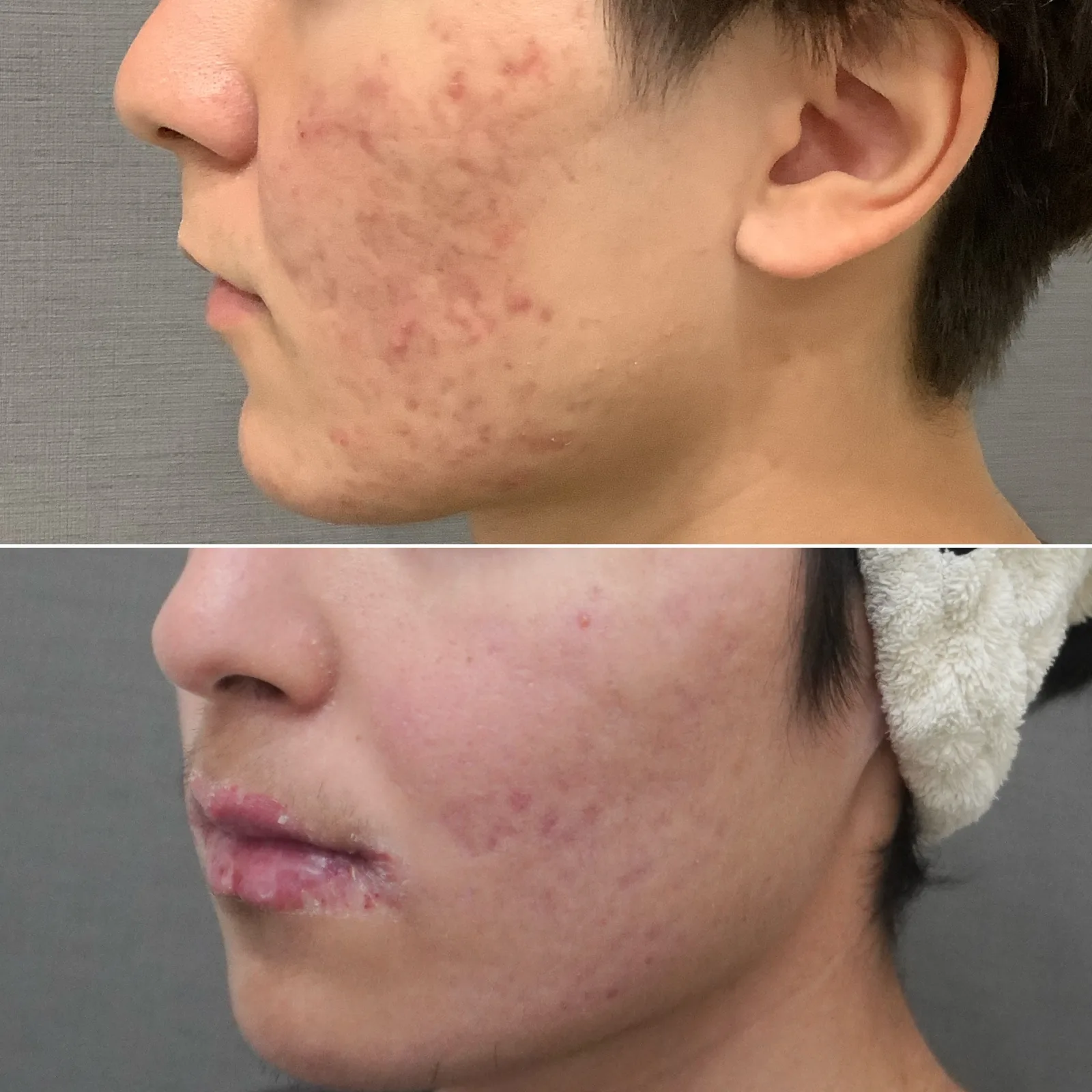 イソトレチノイン内服 症例写真 3 — 活動性ニキビ