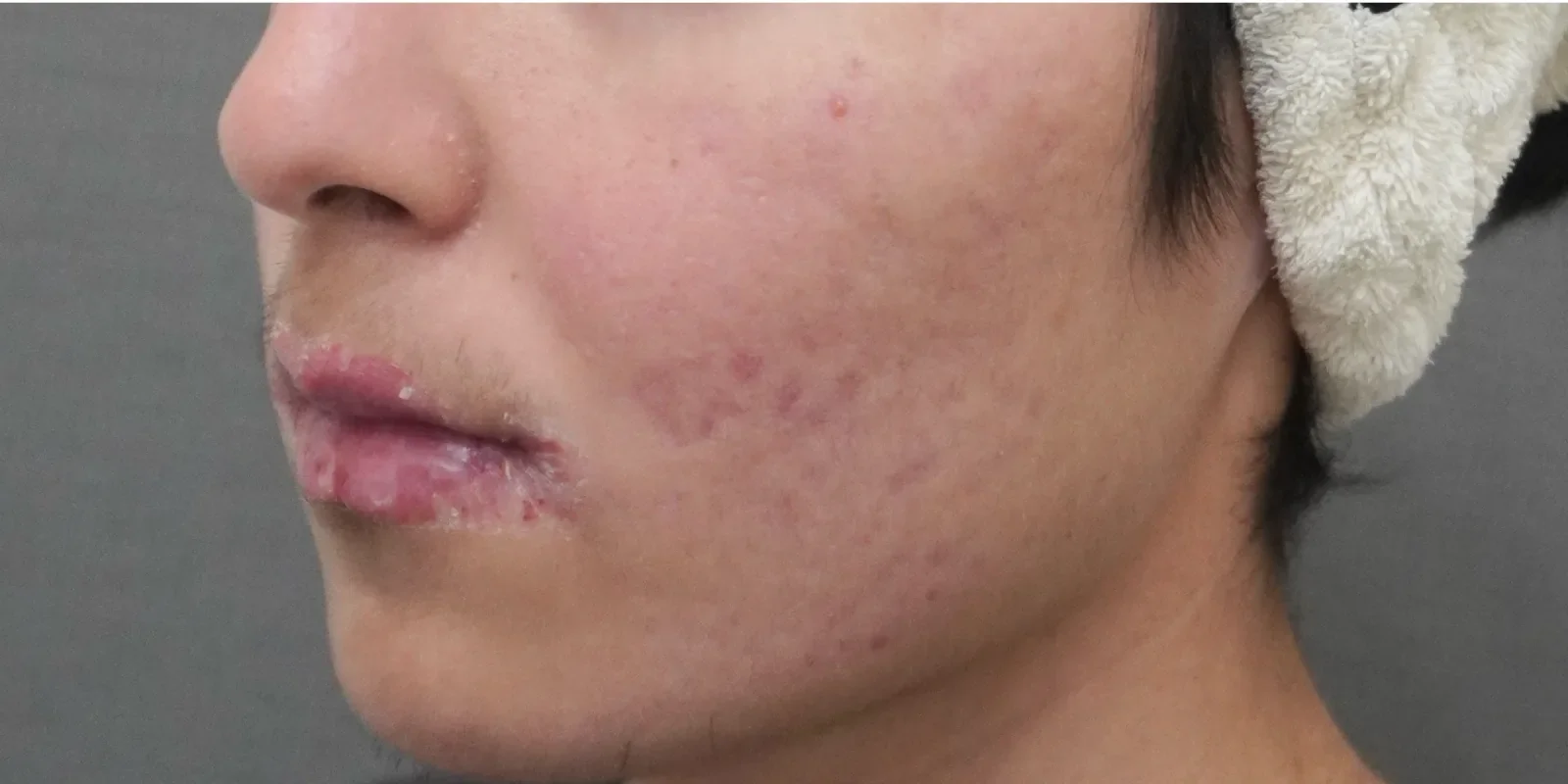 イソトレチノイン 症例B Before/After After