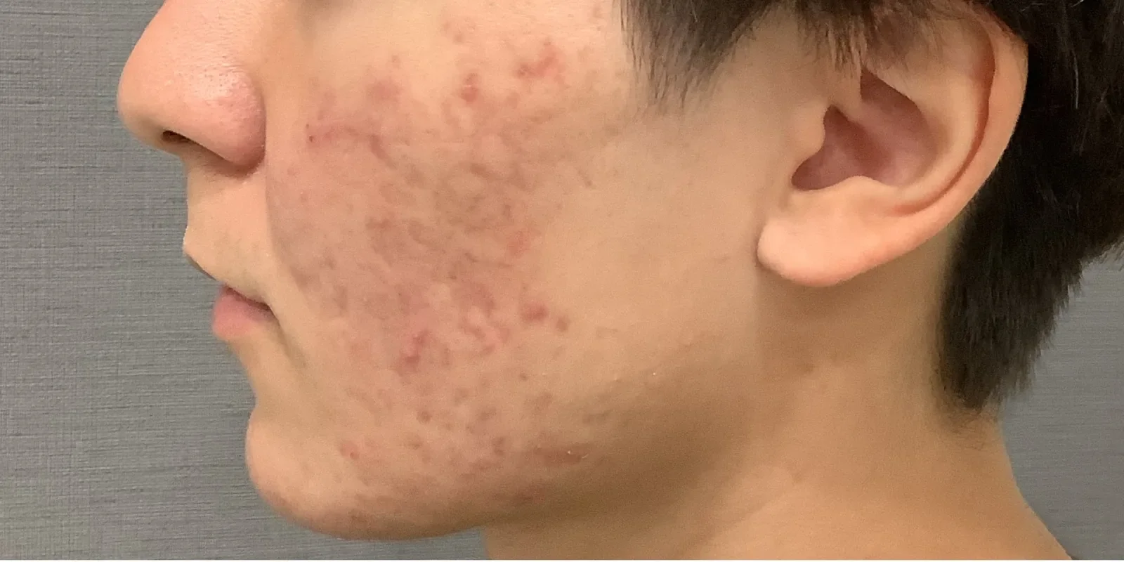 イソトレチノイン 症例B Before/After Before