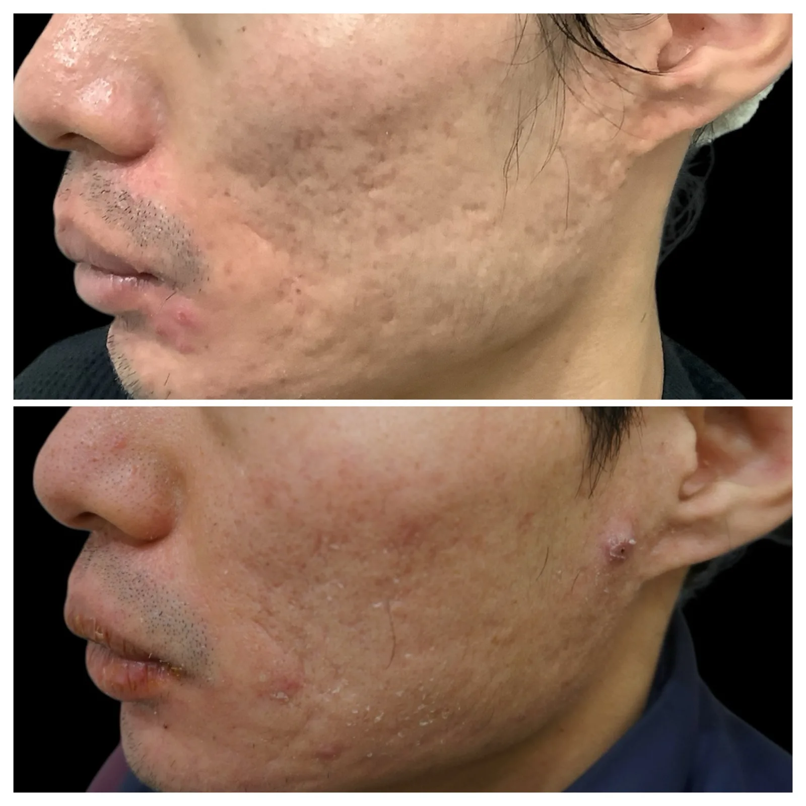 ニキビ跡クレーターへのサブシジョン＋ジュベルック治療 症例