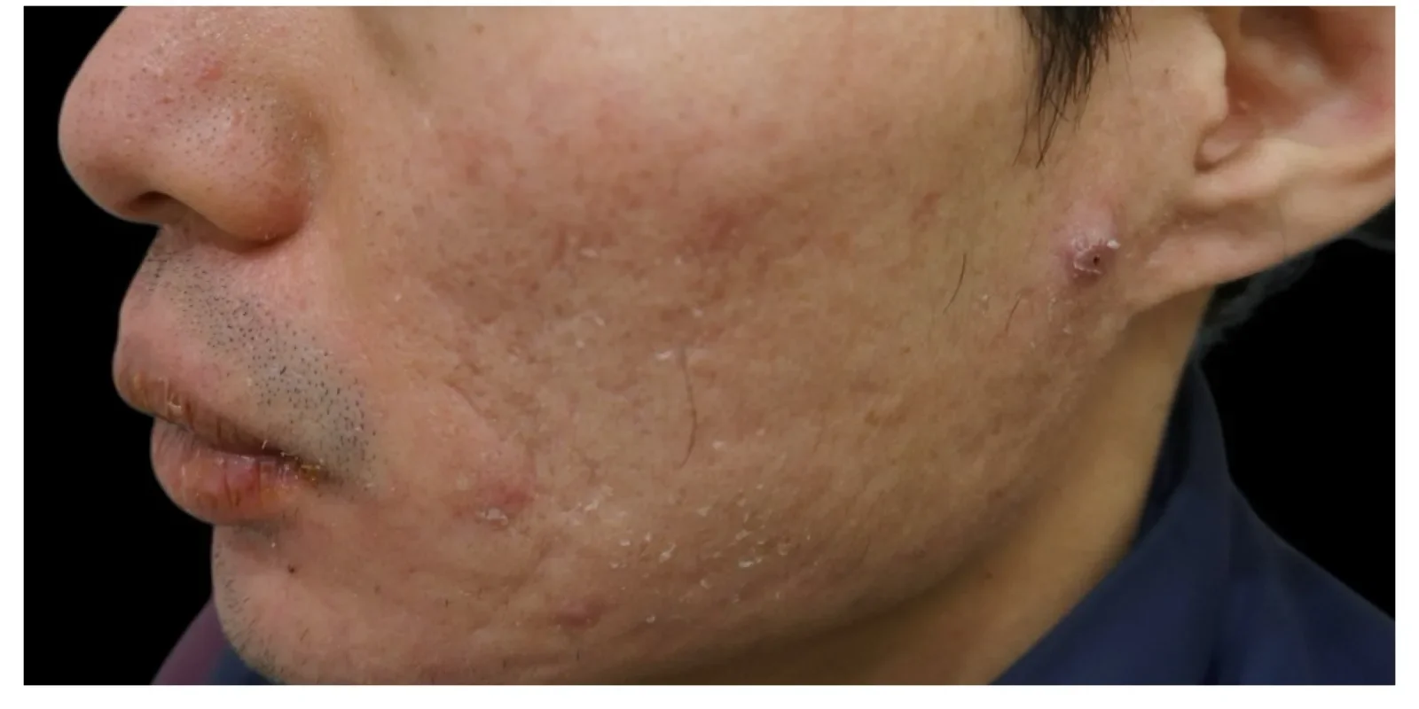 サブシジョン＋ジュベルック Before/After After