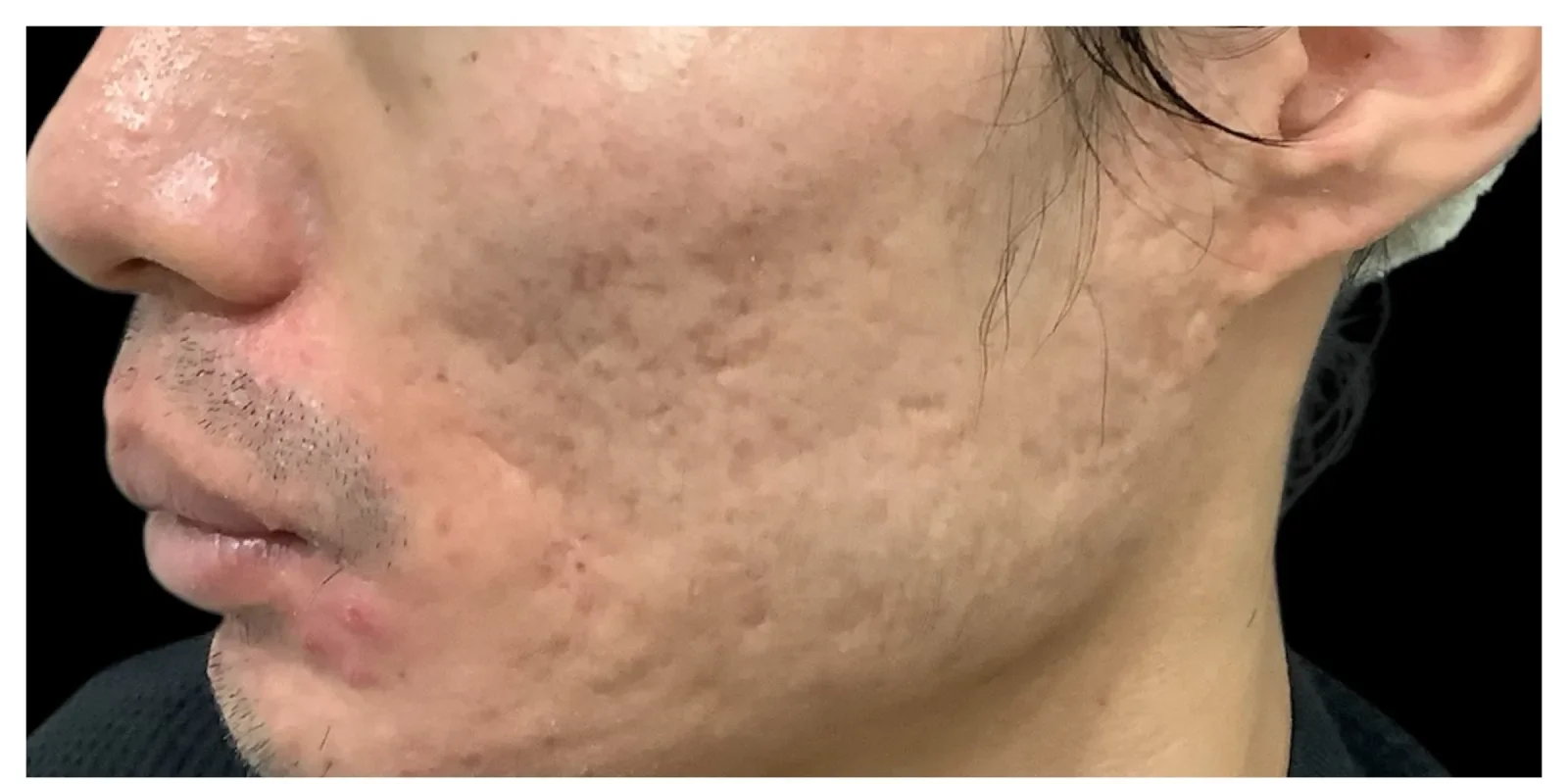 サブシジョン＋ジュベルック Before/After Before