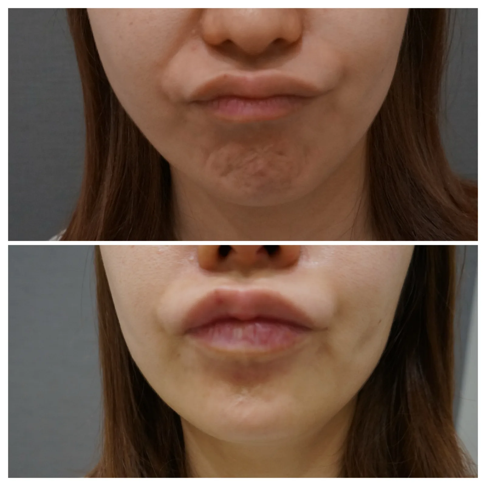 ボトックス（オトガイ筋） 症例写真 7 — 顎（梅干しジワ）