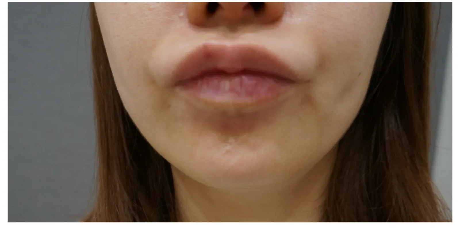 顎ボトックス Before/After After