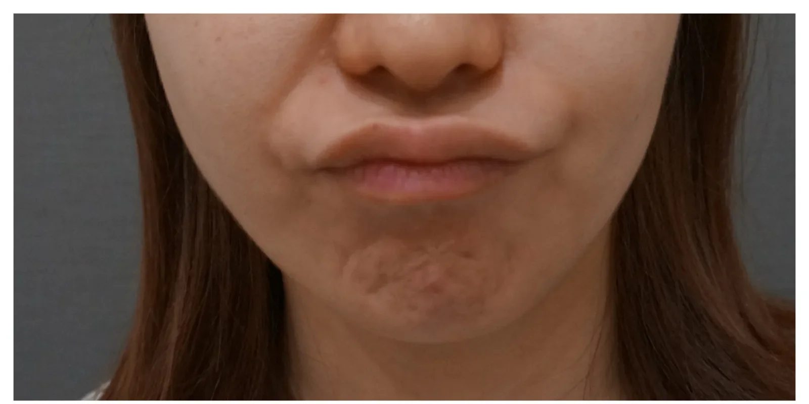 顎ボトックス Before/After Before