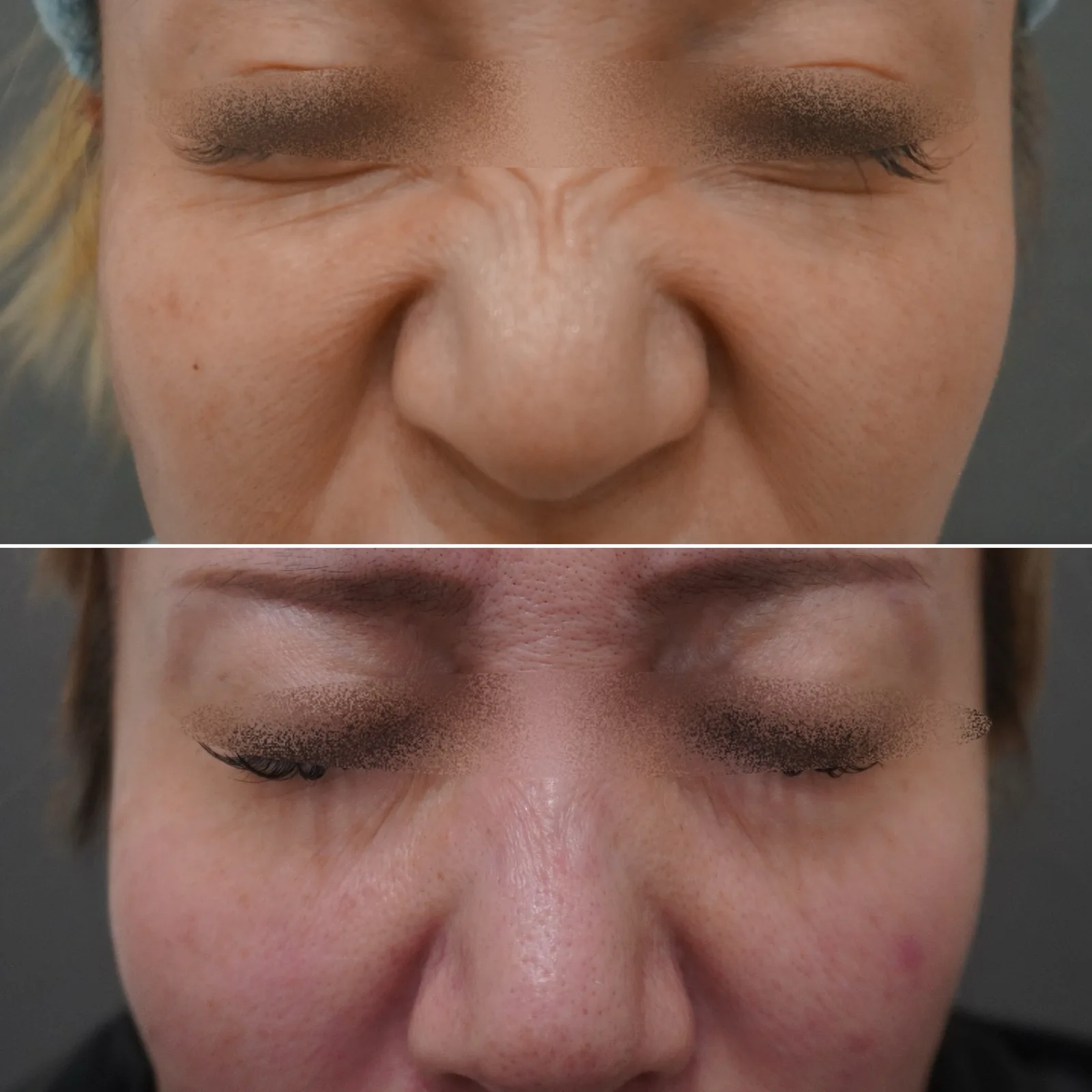 ボトックス（鼻根） 症例写真 4 — バニーライン（鼻根）