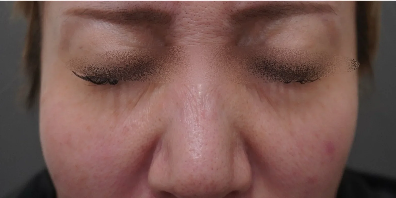 バニーラインボトックス Before/After After