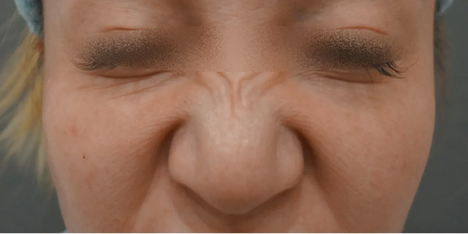 バニーラインボトックス Before/After Before