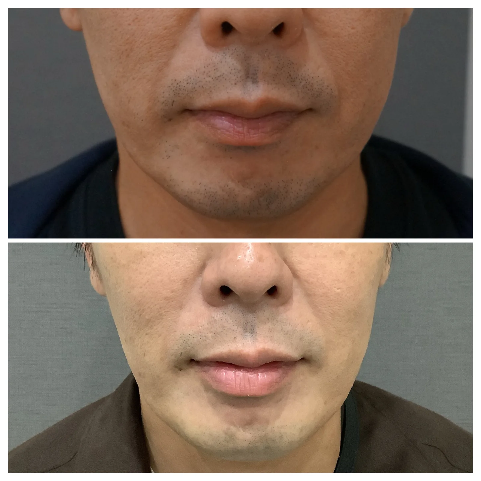 輪郭を整えるボトックス 症例3例 — エラ・オトガイ・ガミースマイルの実例