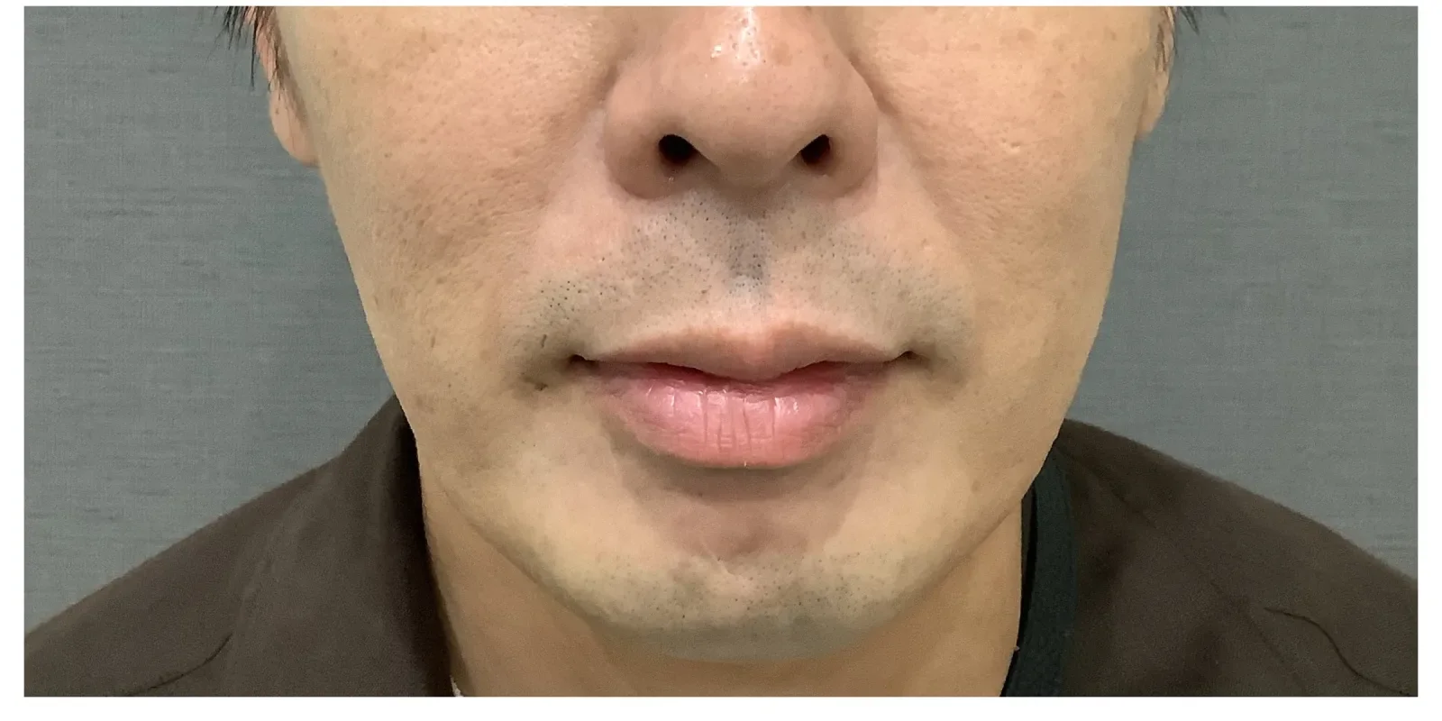 エラボトックス Before/After After