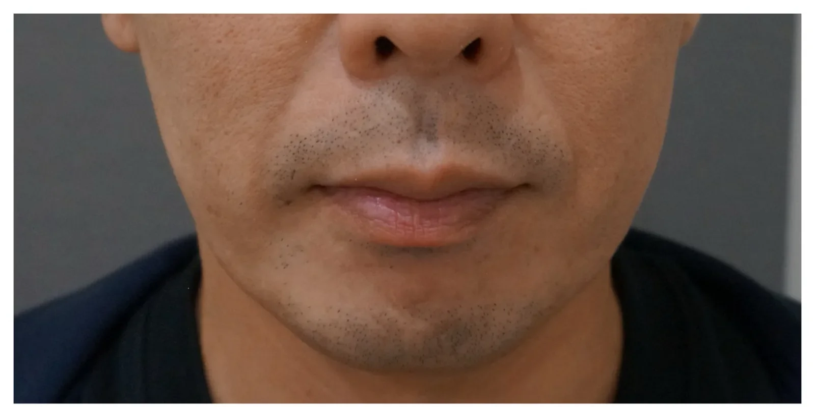 エラボトックス Before/After Before