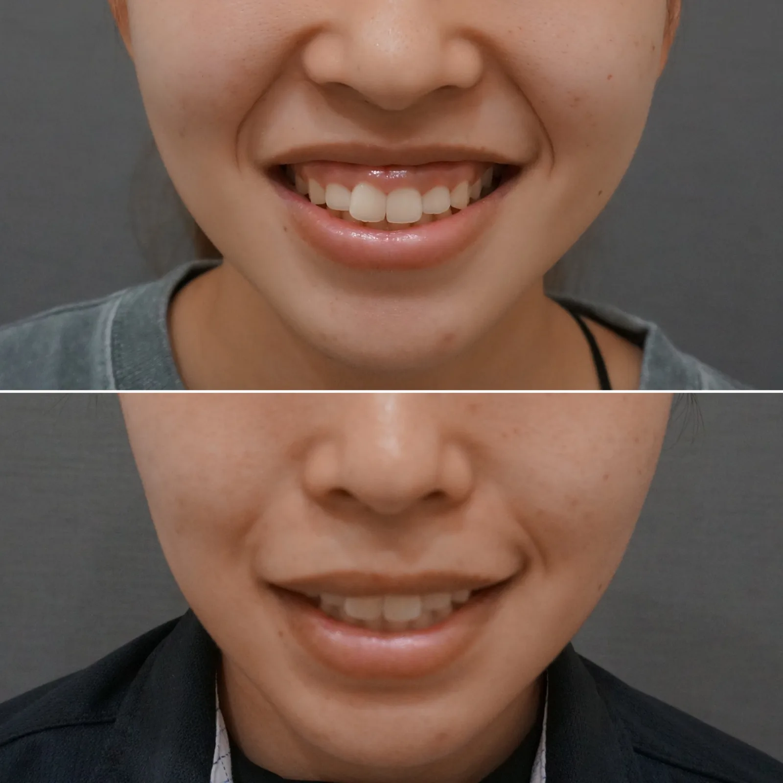 ボトックス（上唇挙筋） 症例写真 8 — ガミースマイル