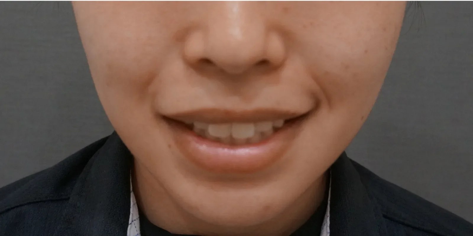 ガミースマイル Before/After After