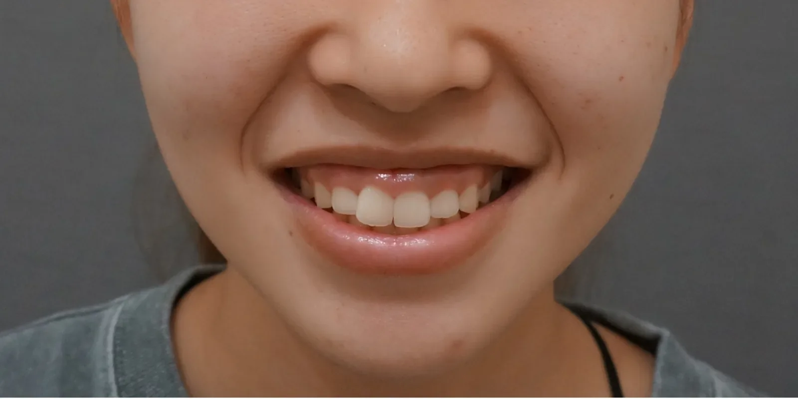 ガミースマイル Before/After Before