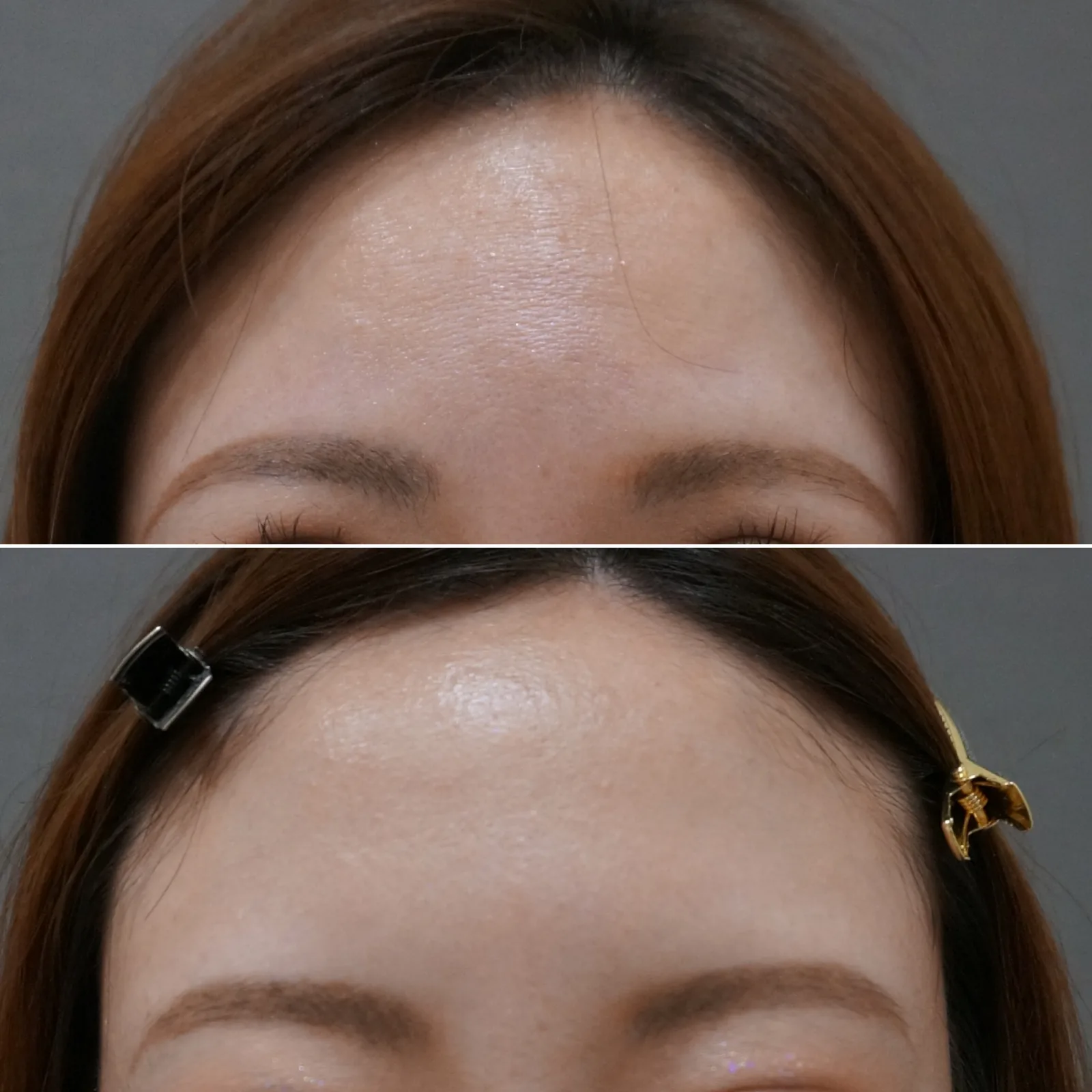 ボトックス（額） 症例写真 2 — 額の横ジワ