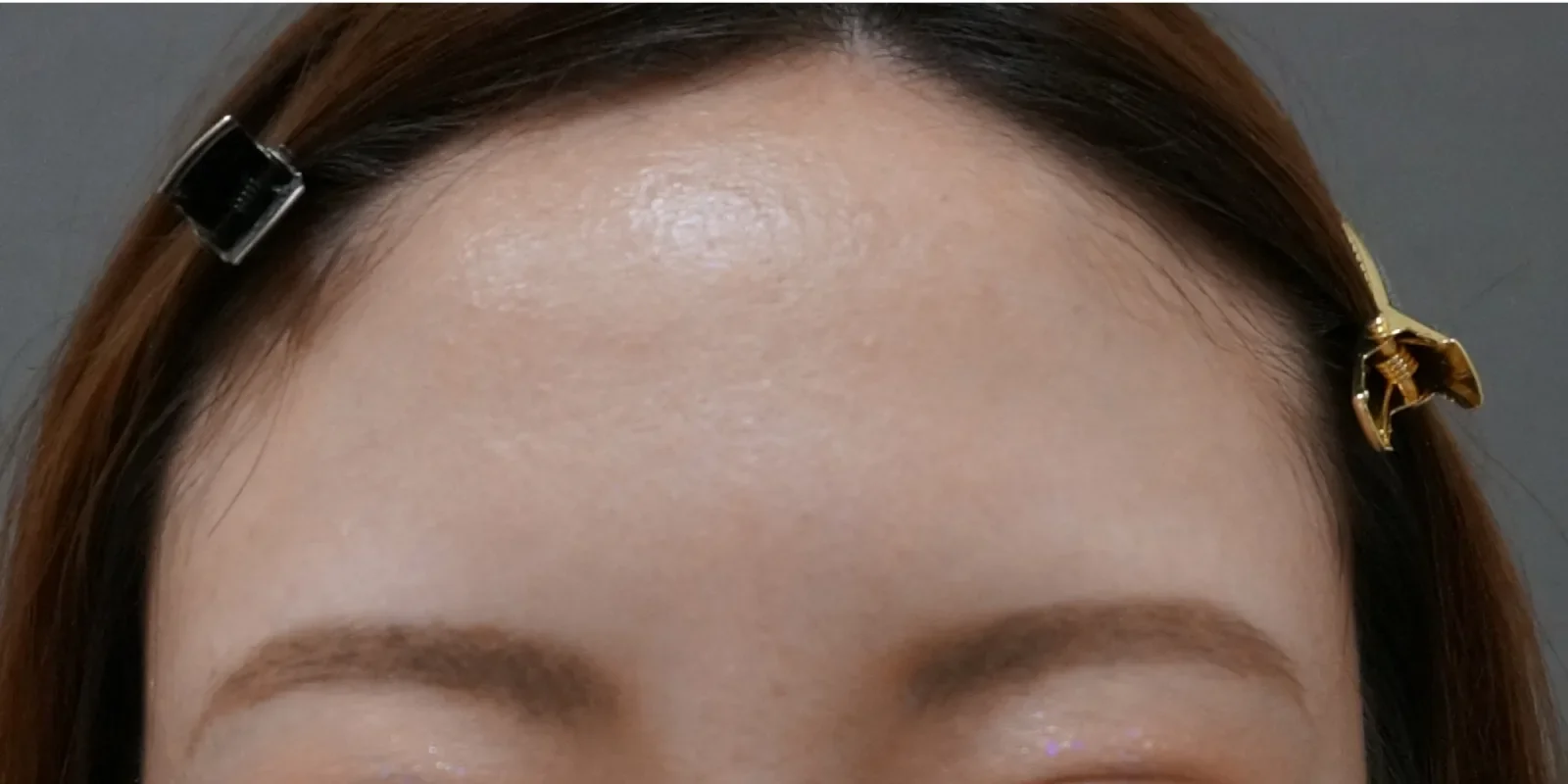 額ボトックス 症例A Before/After After