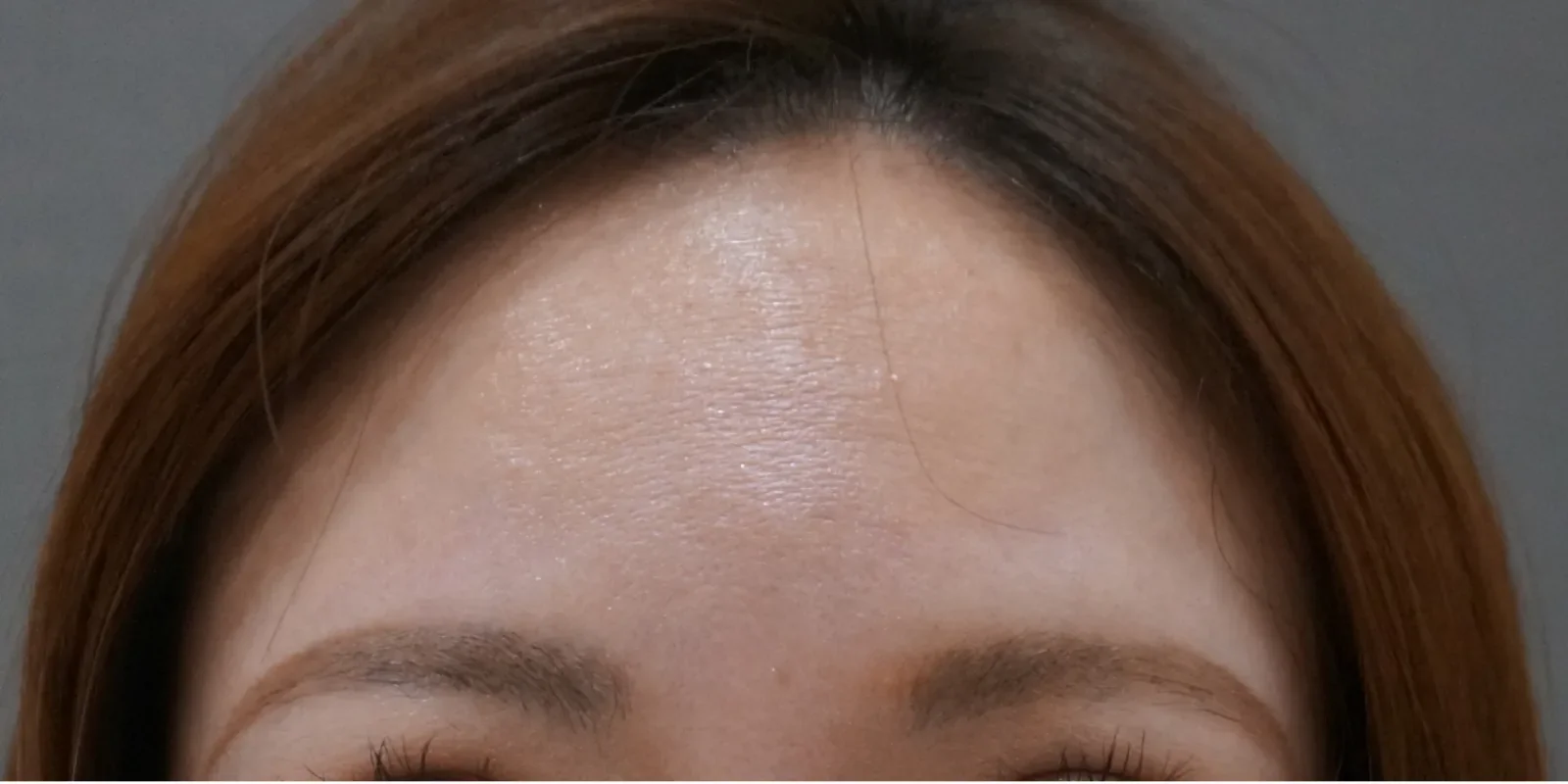 額ボトックス 症例A Before/After Before