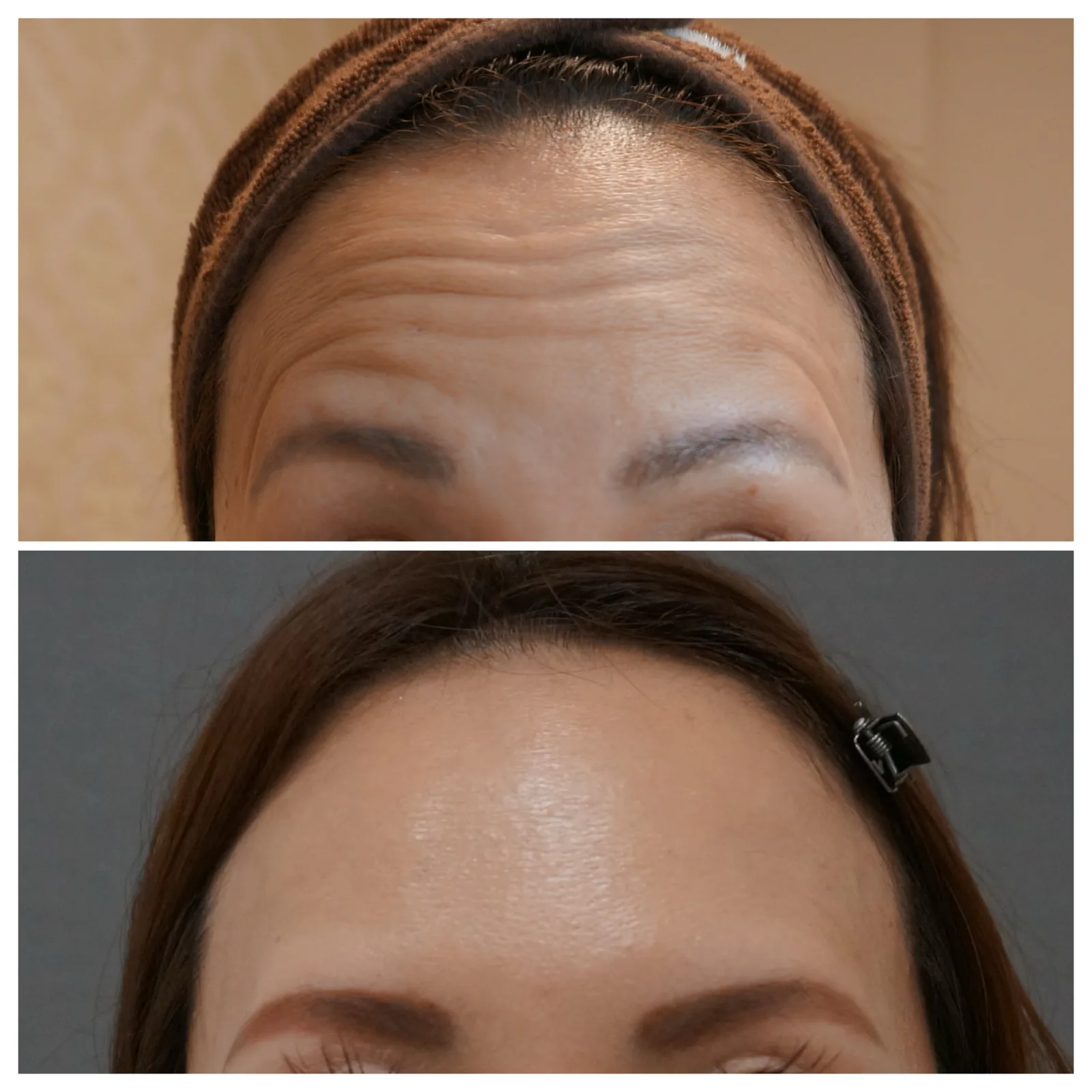 ボトックス（額） 症例写真 3 — 額の横ジワ