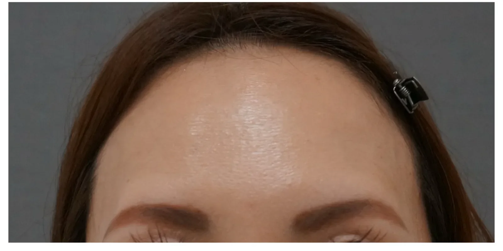 額ボトックス 症例B Before/After After