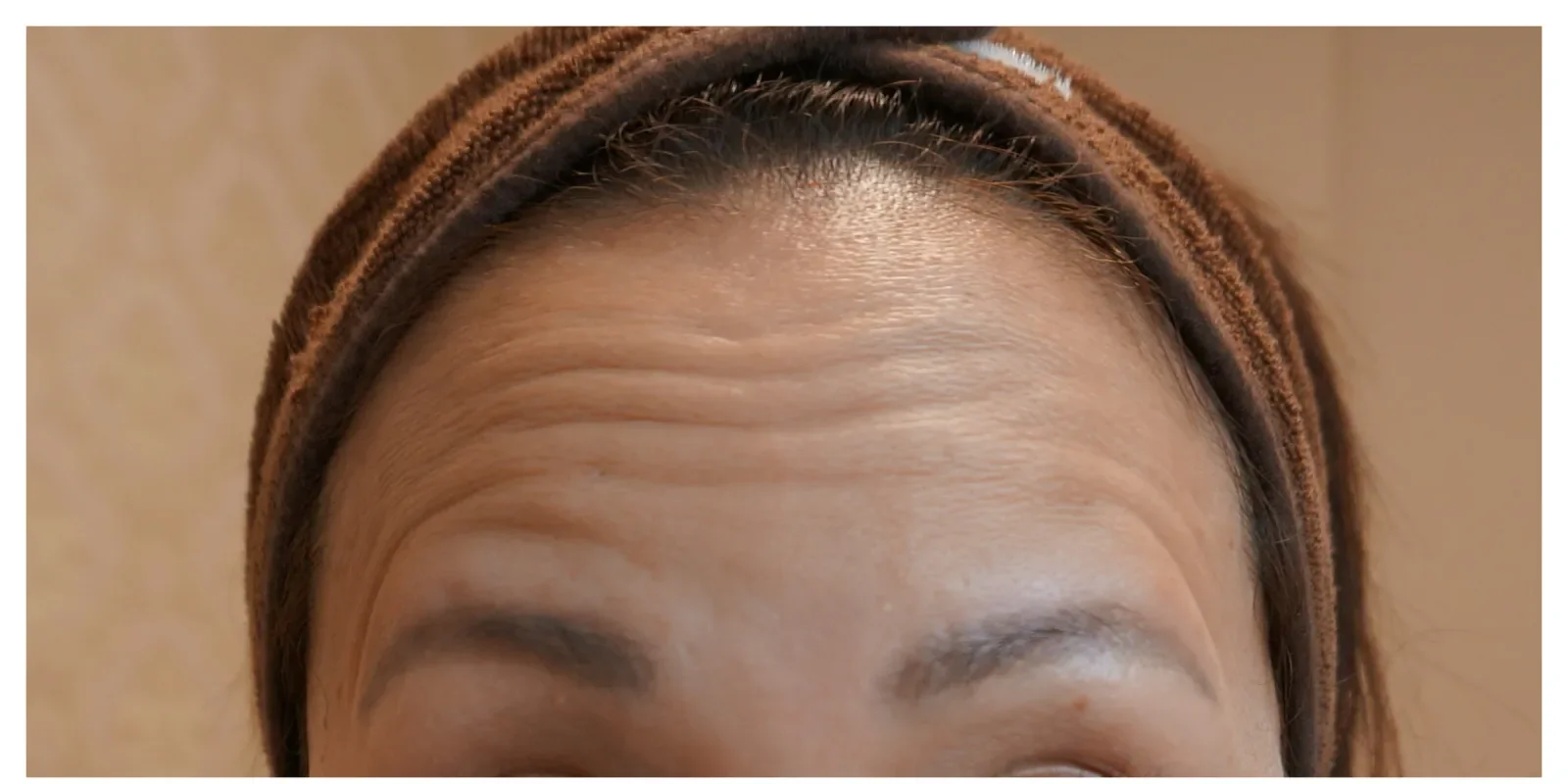 額ボトックス 症例B Before/After Before