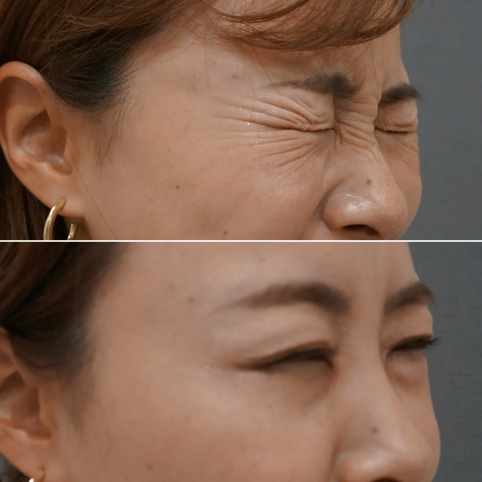 ボトックス（目尻） 症例写真 5 — 目尻の笑いジワ