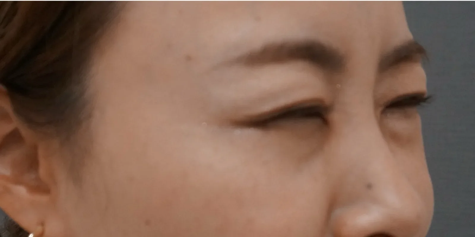 目尻ボトックス Before/After After