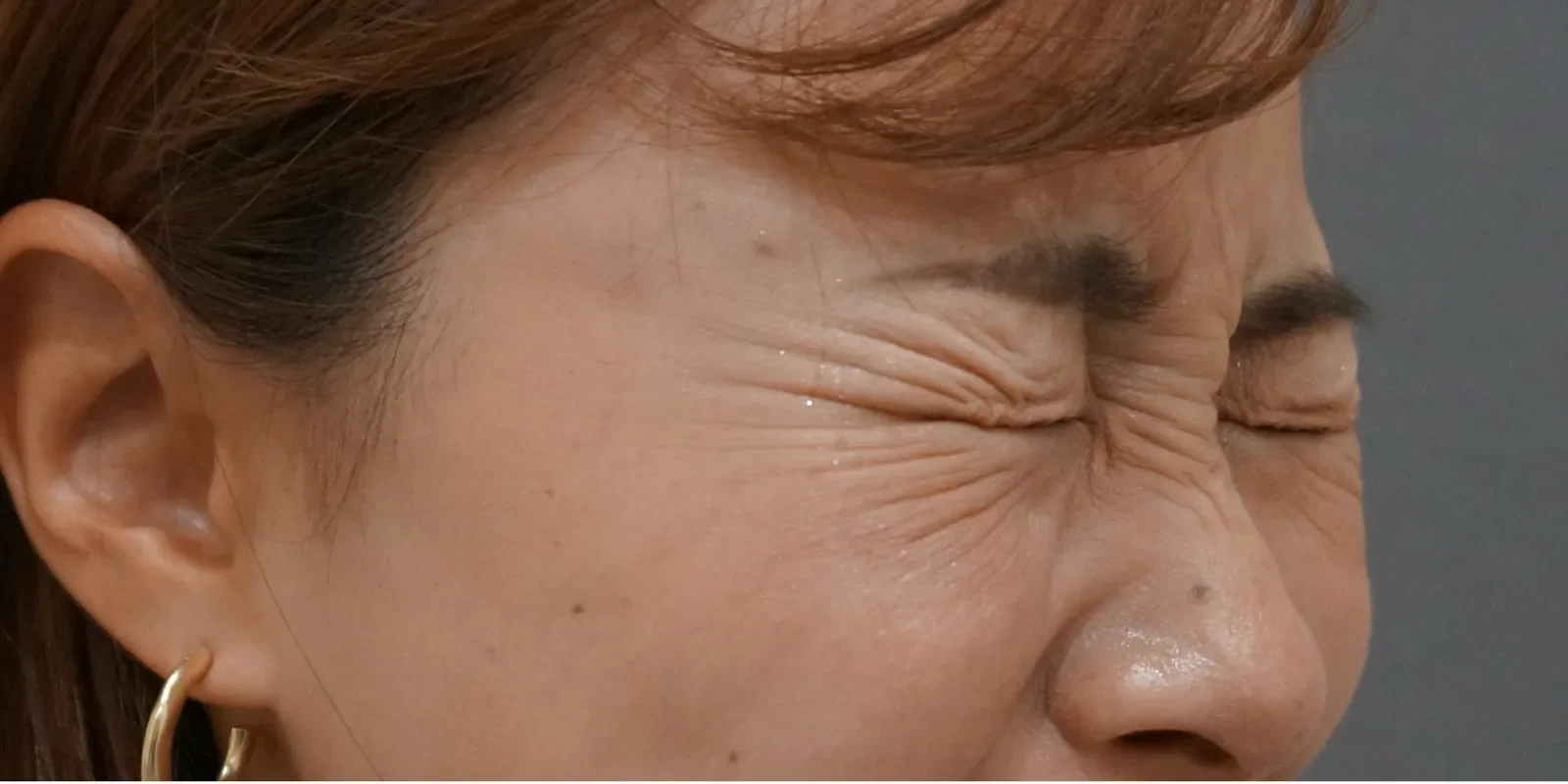 目尻ボトックス Before/After Before