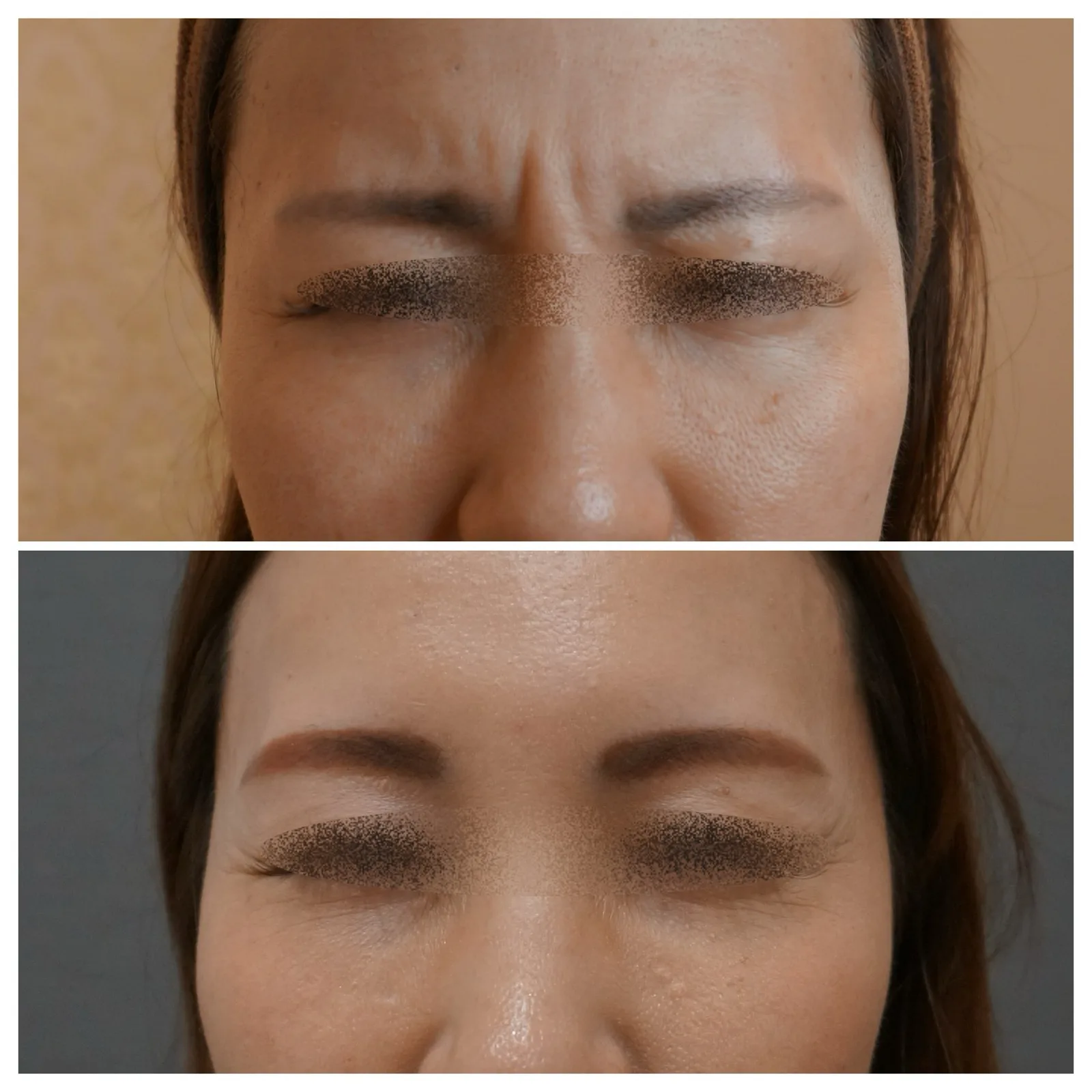 表情ジワへのボトックス治療 症例5例 — 眉間・額・バニーライン・目尻の実例