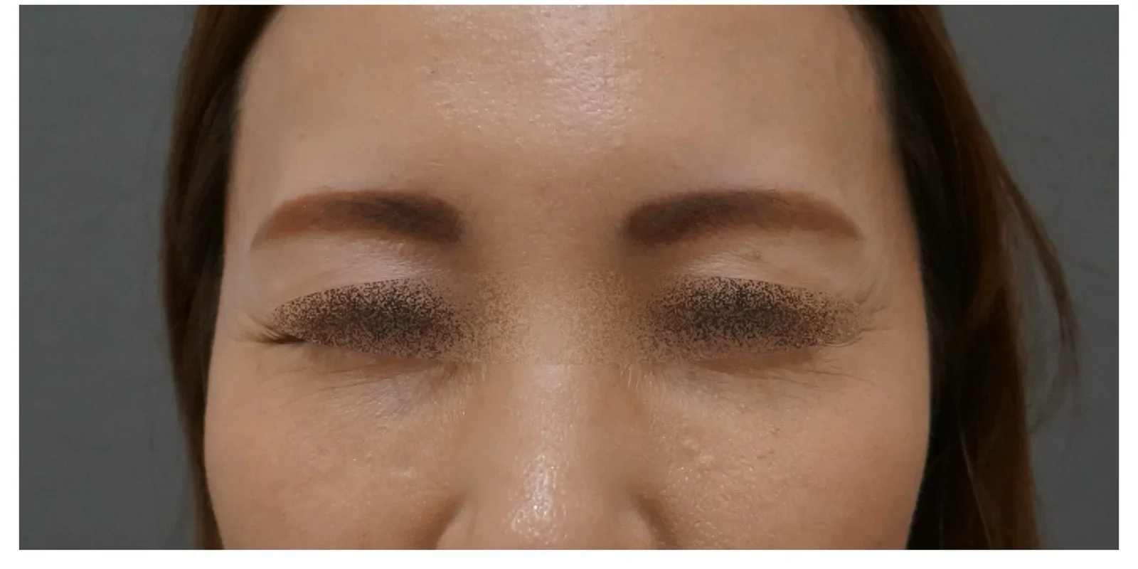 眉間ボトックス Before/After After