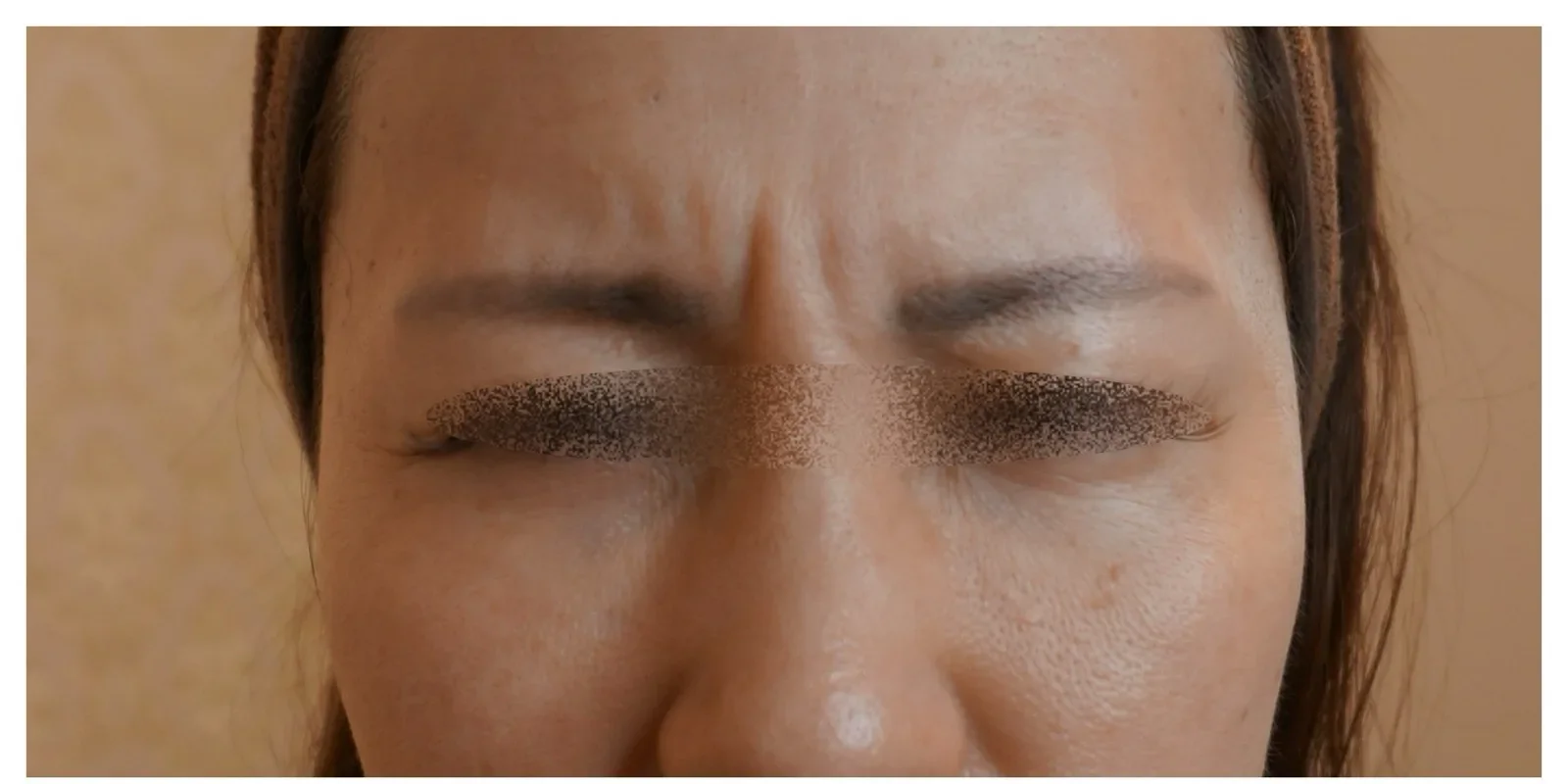 眉間ボトックス Before/After Before