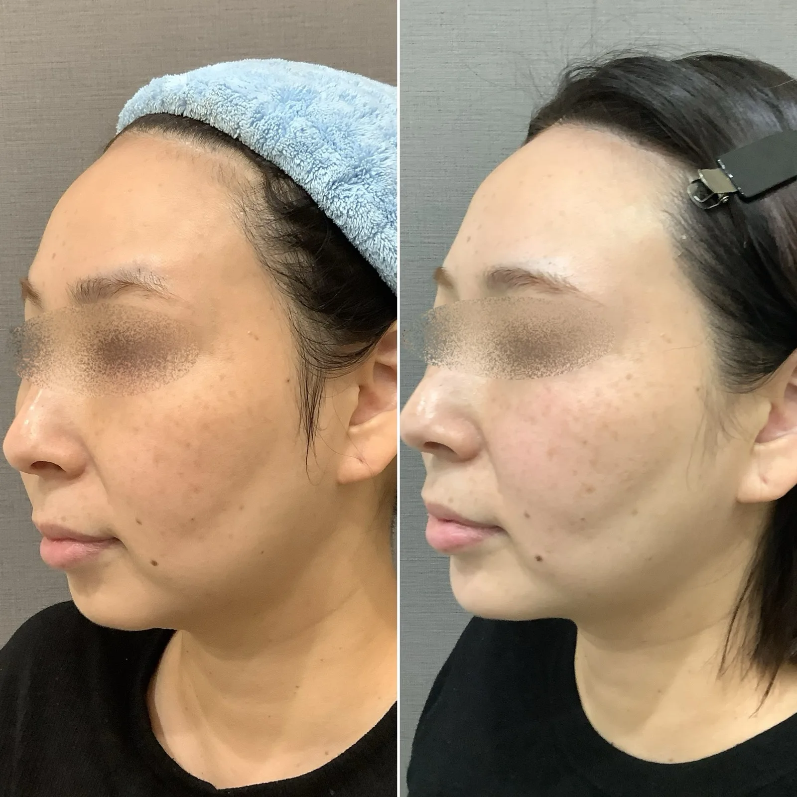 ヒアルロン酸注入 症例写真 3 — 顎（オトガイ形成）