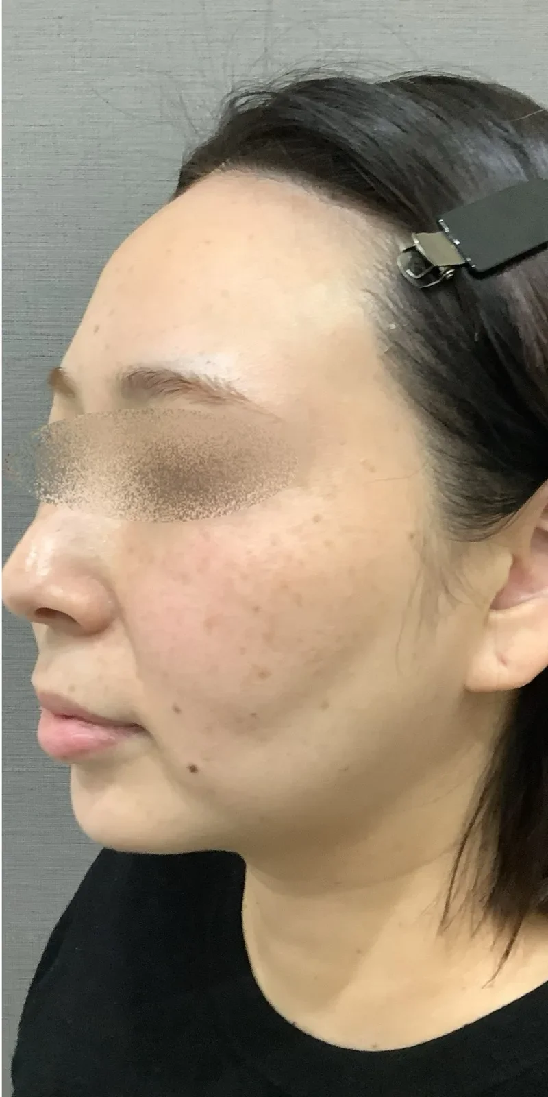 顎ヒアルロン酸 Before/After After