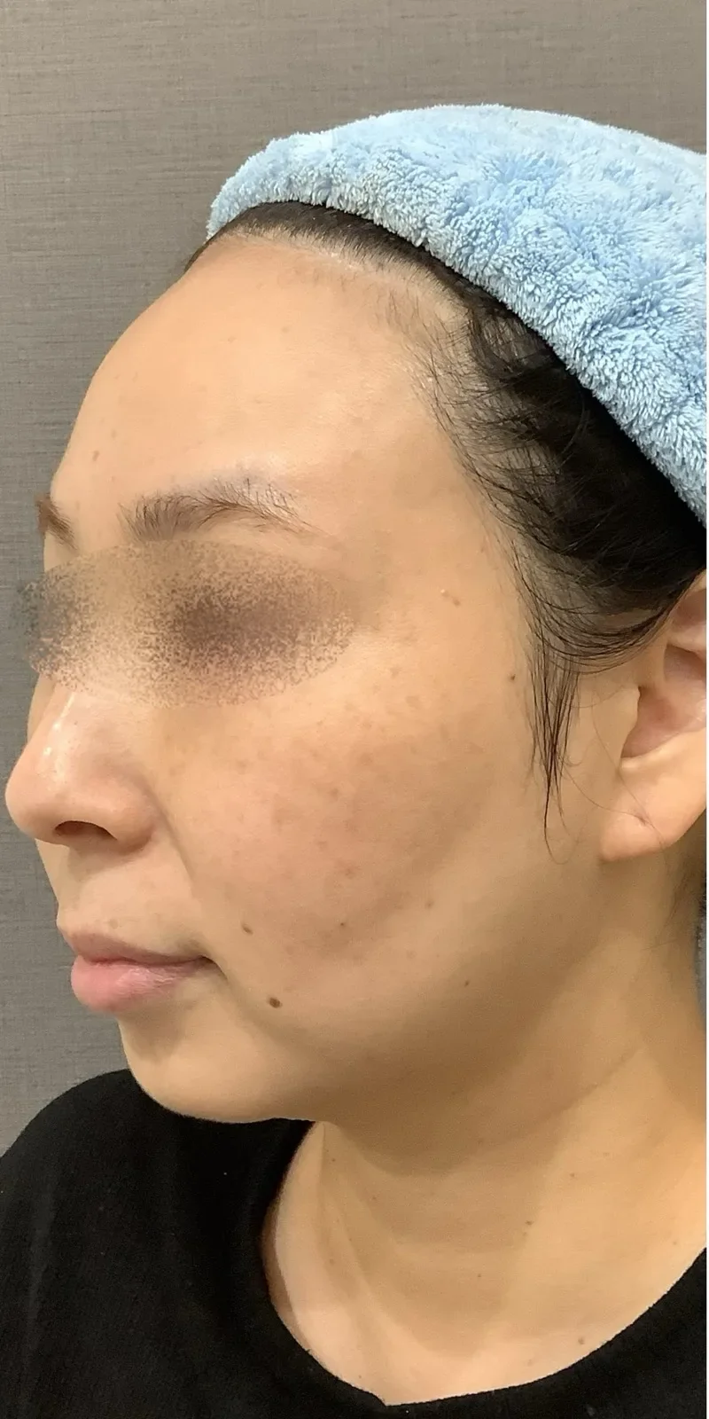 顎ヒアルロン酸 Before/After Before