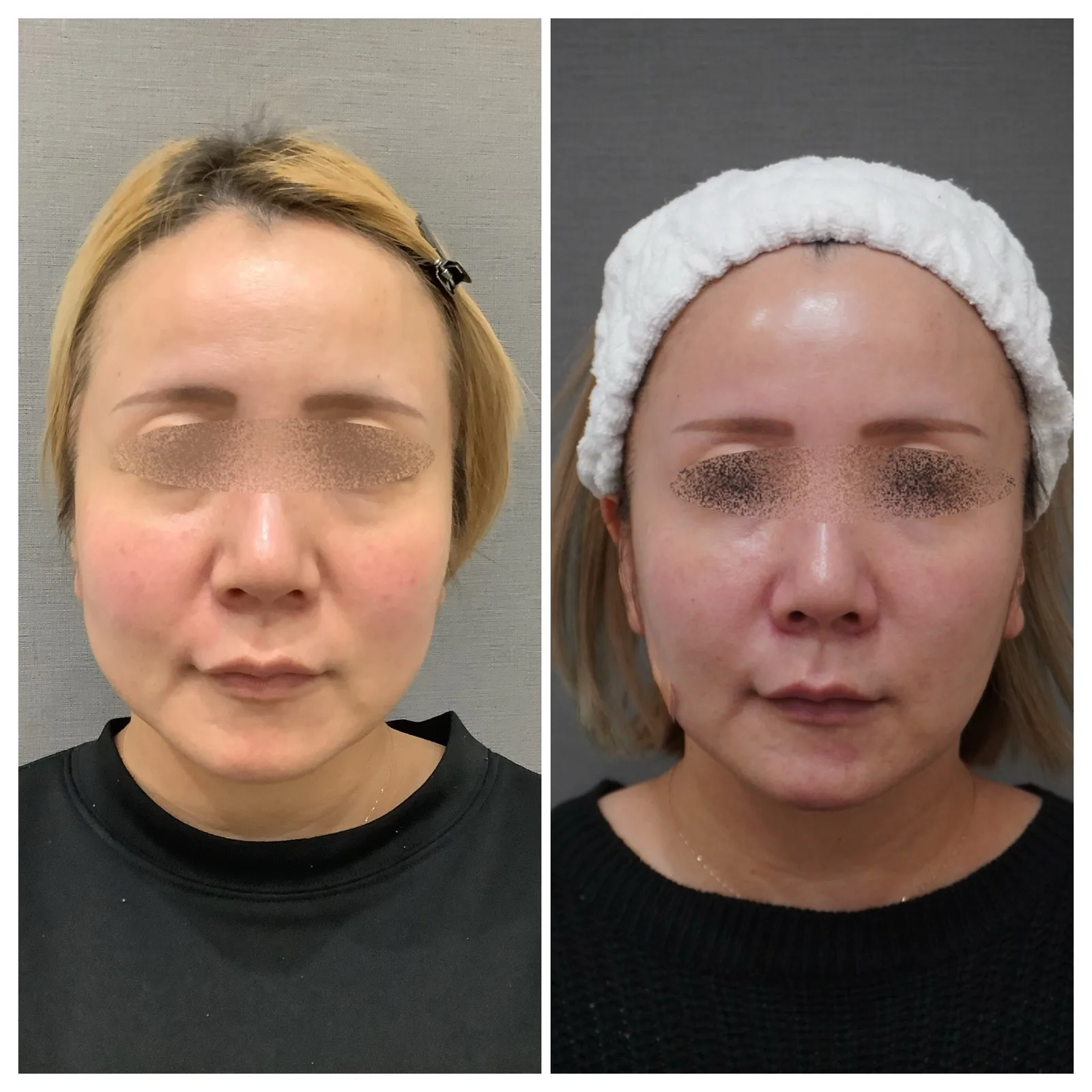 ヒアルロン酸注入 症例4例 — ほうれい線・頬・顎・眉間の実例