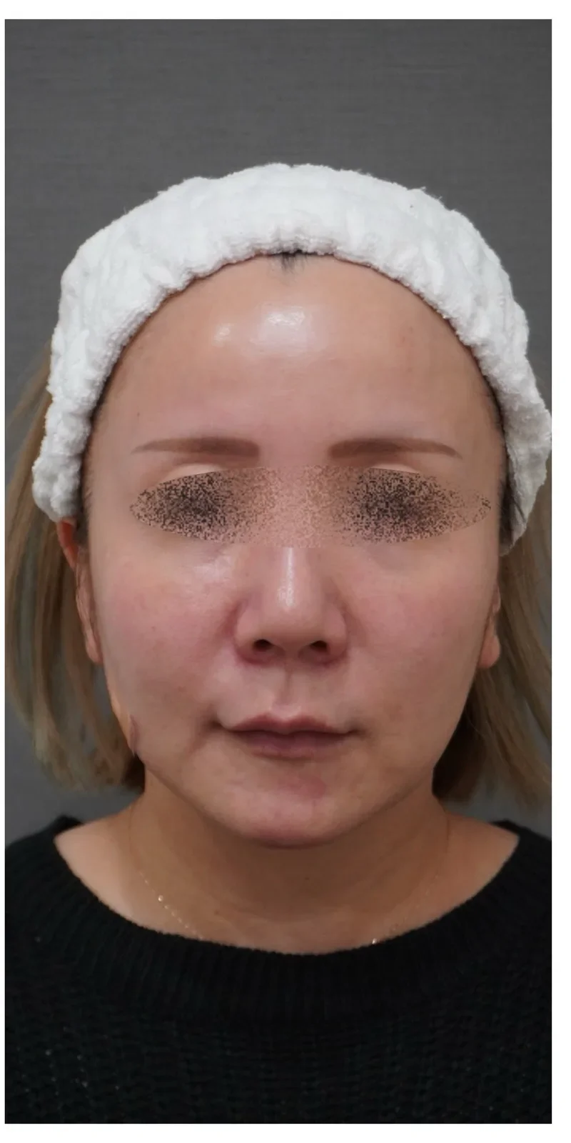 ヒアルロン酸 複合部位 Before/After After