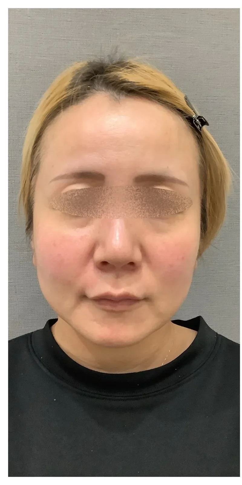 ヒアルロン酸 複合部位 Before/After Before