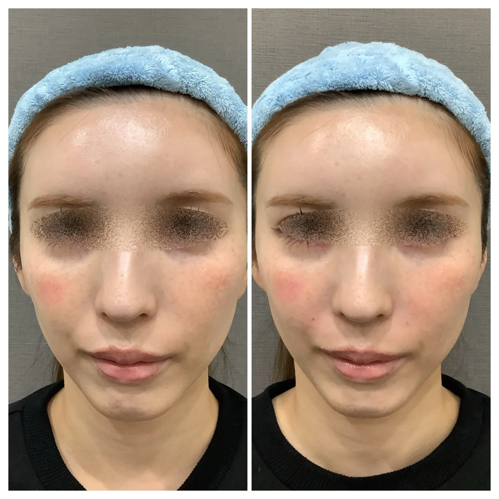 ヒアルロン酸注入 症例写真 2 — ほうれい線