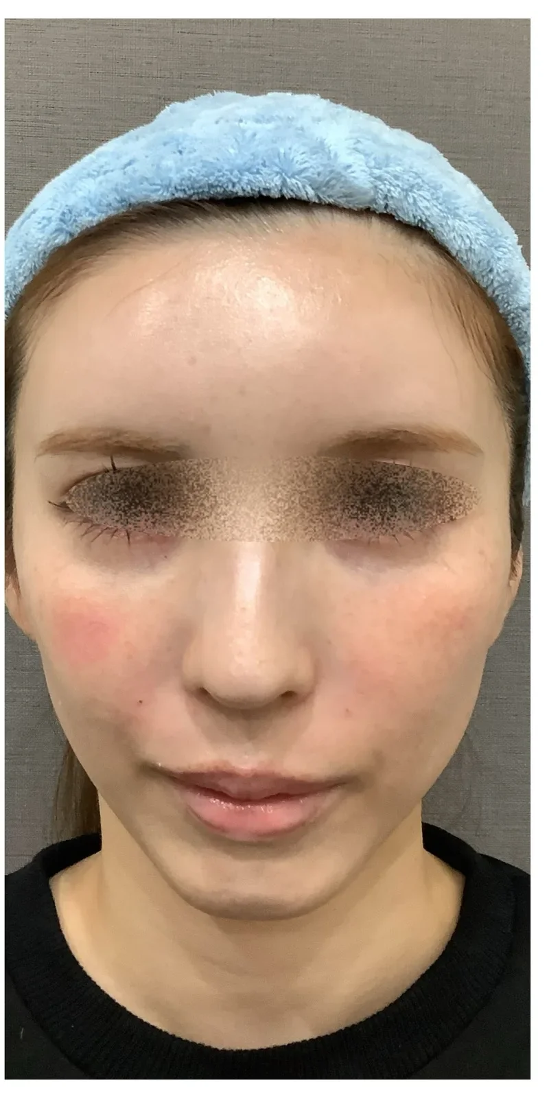 ほうれい線ヒアルロン酸 Before/After After