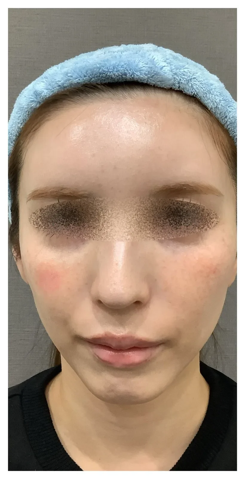 ほうれい線ヒアルロン酸 Before/After Before