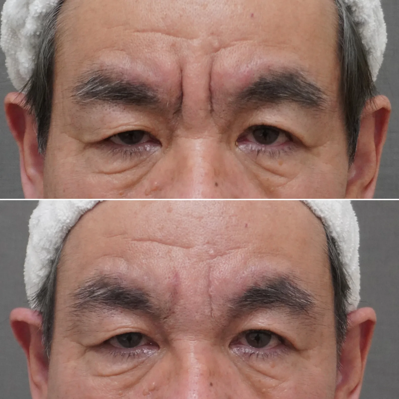ヒアルロン酸＋ボトックス複合治療 症例写真 4 — 眉間（ヒアルロン酸＋ボトックス）