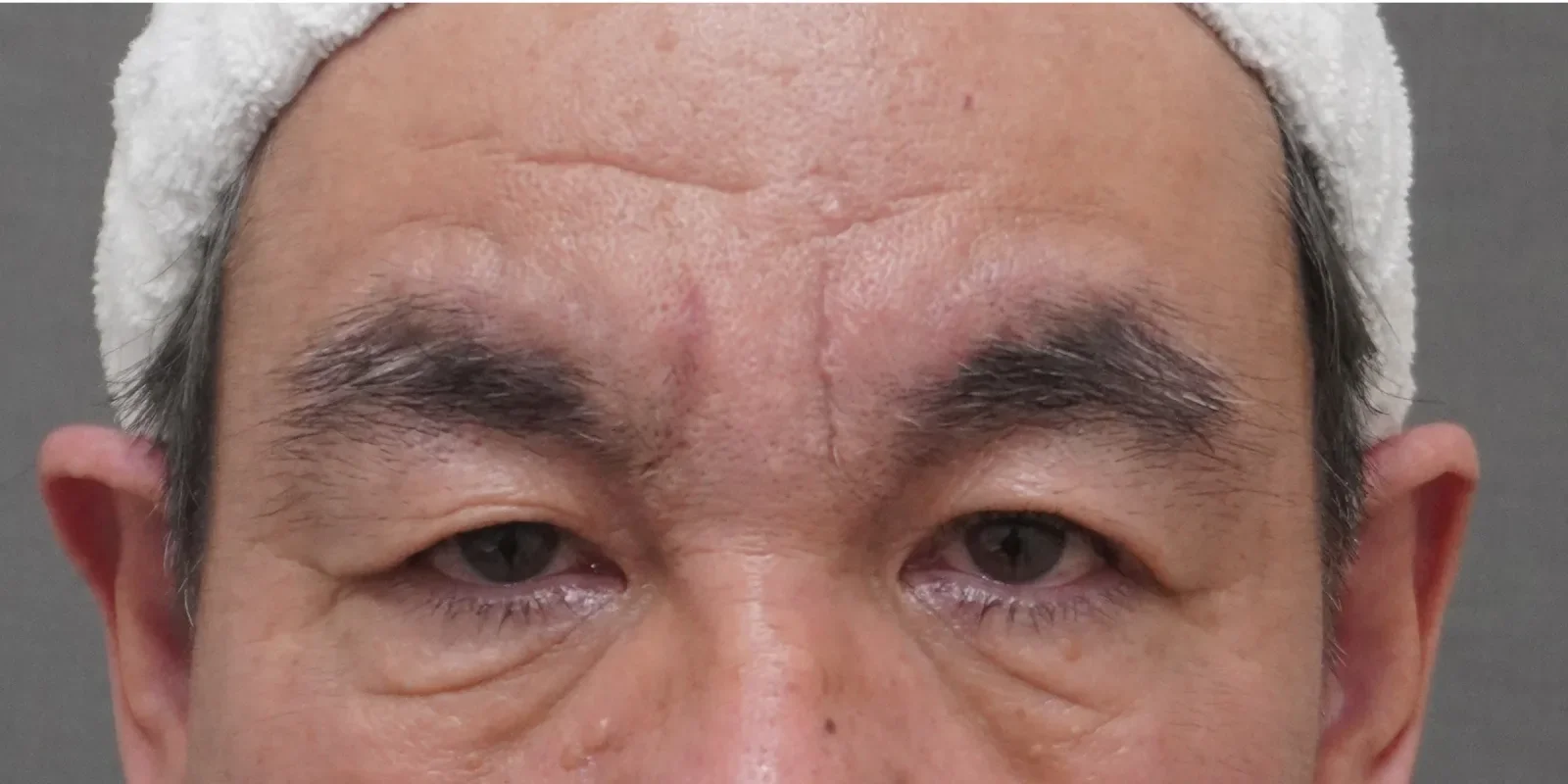 眉間 ヒアルロン酸＋ボトックス Before/After After