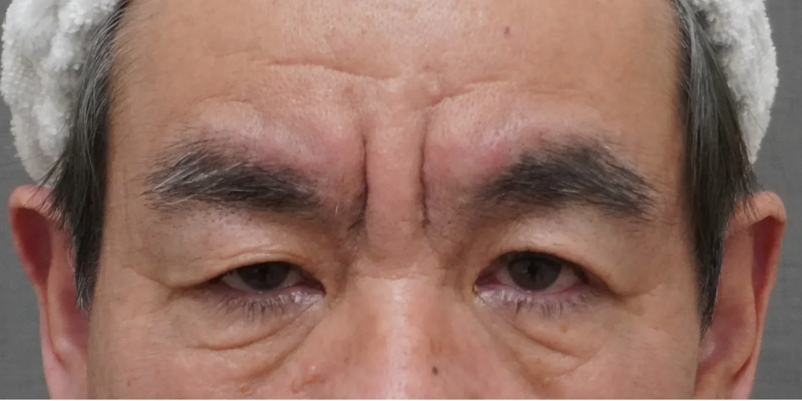 眉間 ヒアルロン酸＋ボトックス Before/After Before