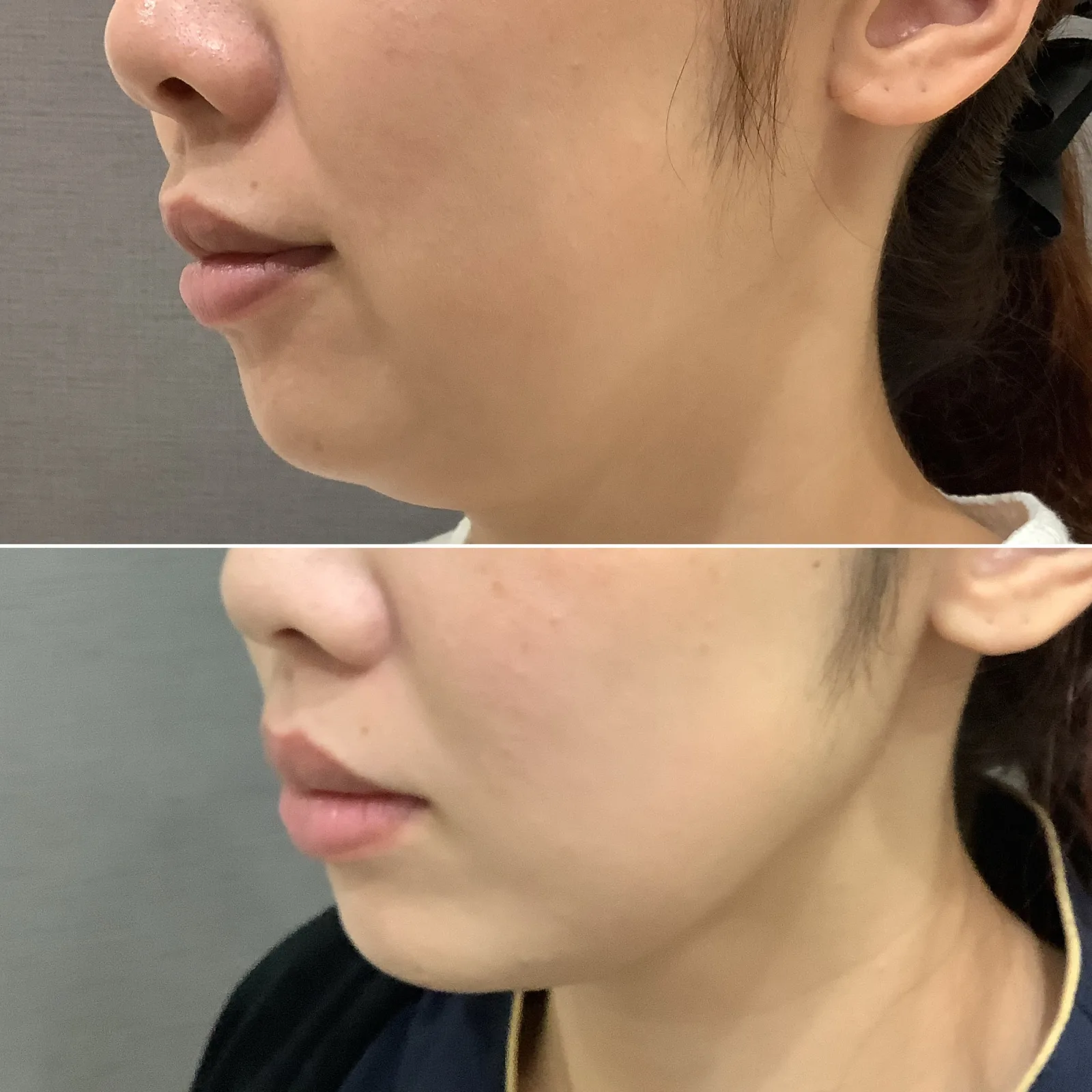 リヴァイブ（Re:vive） 症例写真 1 — 顎下（二重あご）