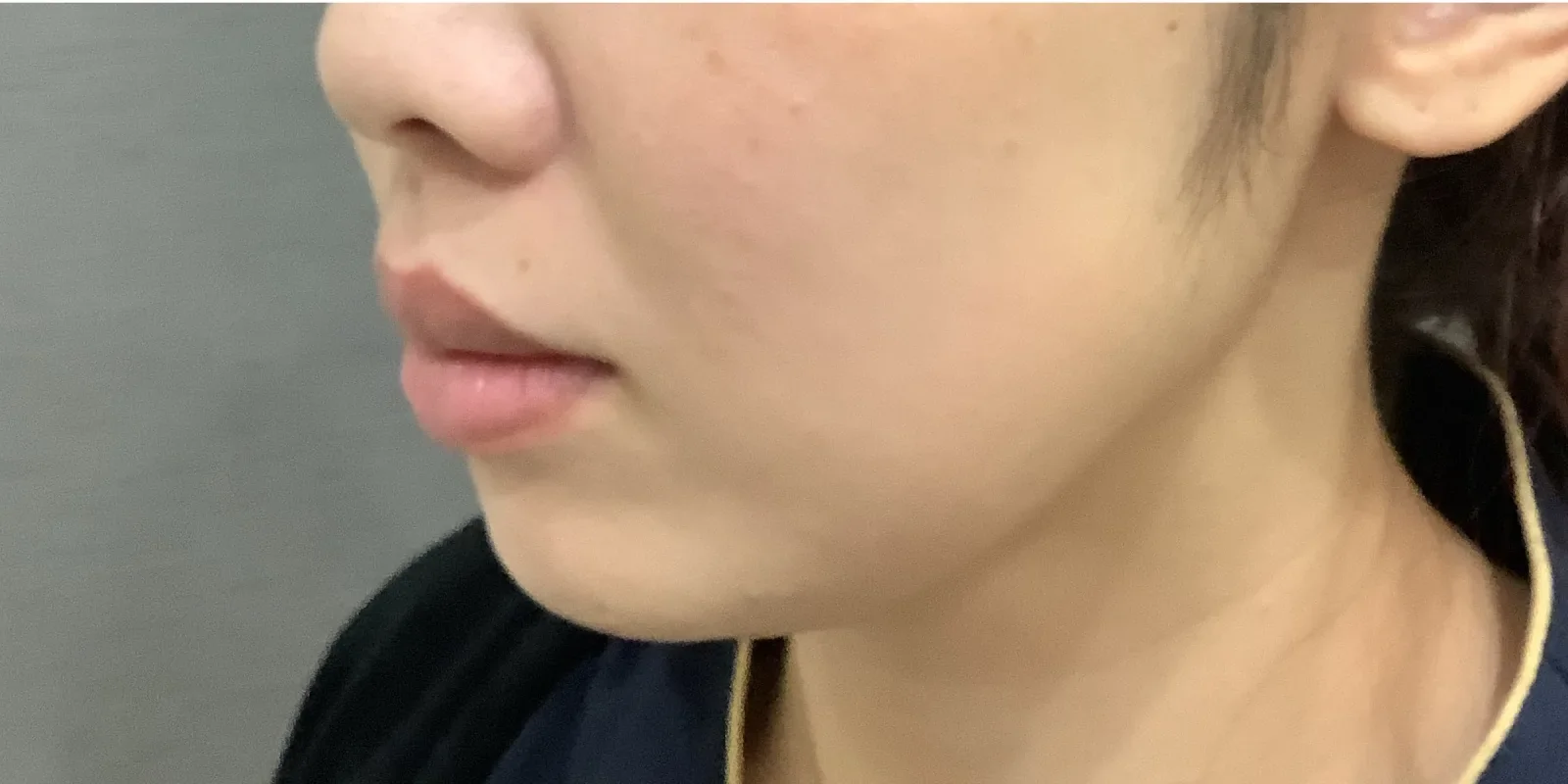 リヴァイブ 顎下 Before/After After